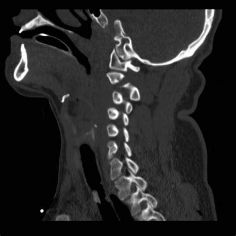 Hangman fracture | Radiology Case | Radiopaedia.org | Radiology ...