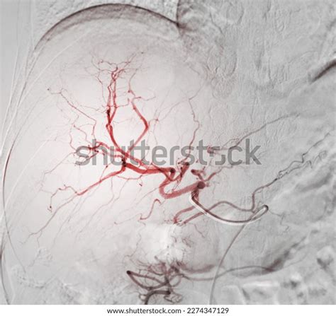 Imaging Tace Chemoembolization Procedure That Allows Stock Illustration 2274347129 | Shutterstock