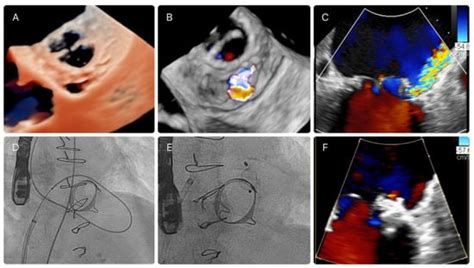 THE CHRONIC LEAKY MITRAL VALVE • MyHeart