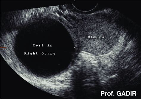 Functional Ovarian Cyst Ultrasound