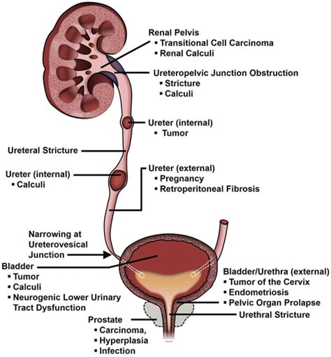 Ureteral Stents, Nephrostomy Tubes, and Urethral Dilators | Abdominal Key