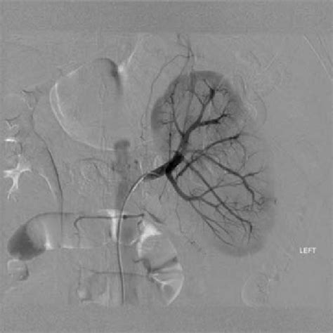 Renal angiogram with no evidence of active extravasation. | Download Scientific Diagram