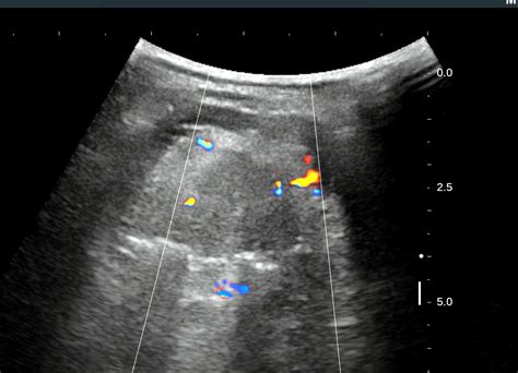 VIETNAMESE MEDIC ULTRASOUND: CASE 398: ECTOPIC THYROID GLAND, Dr PHAN THANH HẢI, Dr TRẦN THỊ BẢO ...