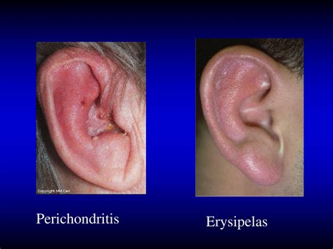 PPT - Anatomy of ear &diseases of external ear and acute otitis media PowerPoint Presentation ...