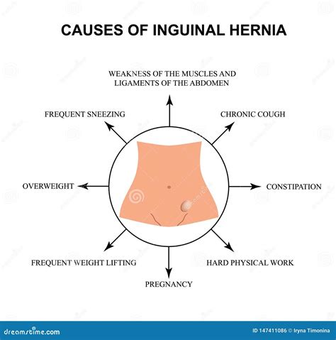 Causes of Inguinal Hernia. Infographics. Vector Illustration on Isolated Background. Stock ...