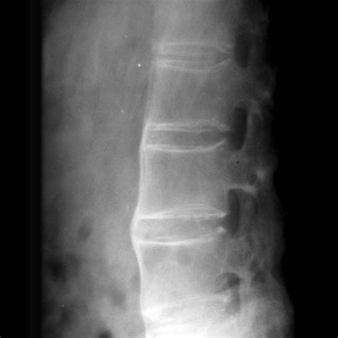 Ankylosing Spondylitis Thoracic Spine