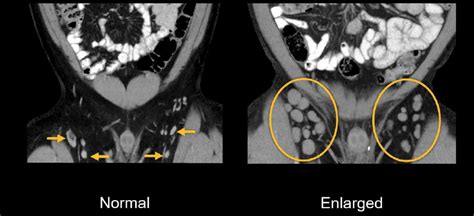 Abdominal CT: lymph nodes • LITFL • Radiology Library