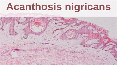 Acanthosis Nigricans - Pathology mini tutorial - YouTube