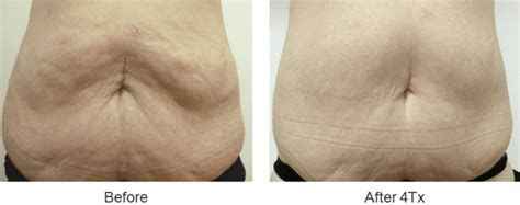 Body Contouring Before and After Images | Tampa Rejuvenation