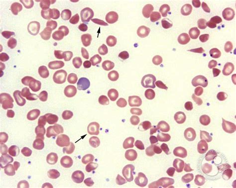 Thalassemia: Leases of life