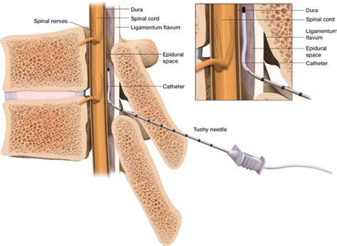 NarkosguidenEpiduralanestesi - Narkosguiden