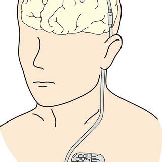 Scheme of electrical motor cortex stimulation. | Download Scientific Diagram