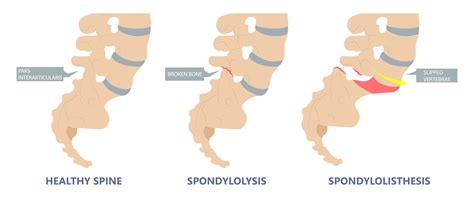 Cervical & Lumbar Spondylosis Pain and Treatment | AllSpine