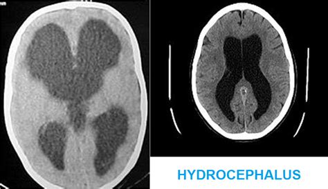 MBBS Medicine (Humanity First): CT SCAN OF HEAD