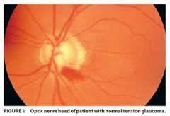 Normal Tension Glaucoma in Vadodara, Eye Hospital | ID: 6866896055