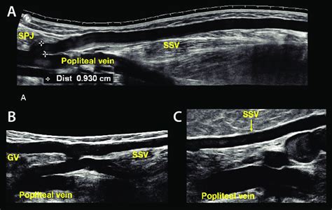 Saphenopopliteal (SPJ-SSV) variations. Panoramic view of the SPJ and... | Download Scientific ...