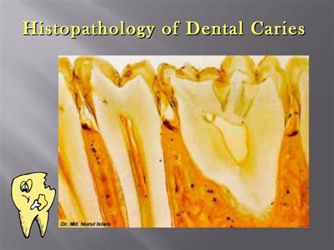 Histopathology Of Dental Caries