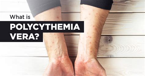 What Does Polycythemia Vera Mean?