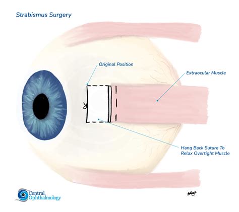 Strabismus (Squint), Sunshine Coast Squint Surgery