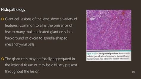 Central giant cell granuloma