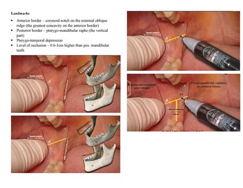 Inferior Alveolar Nerve Block Landmarks