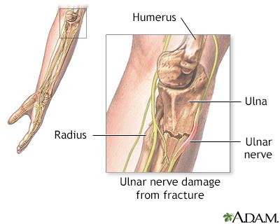 Ulnar nerve dysfunction Information | Mount Sinai - New York