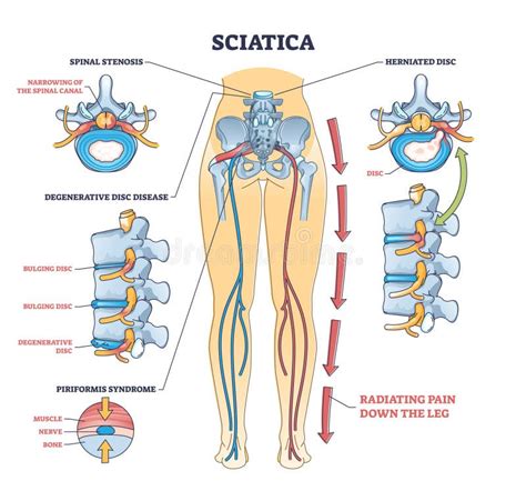 Sciatica Pain or Nerve Weakness As Leg Lumbar Radiculopathy Outline Diagram Stock Vector ...