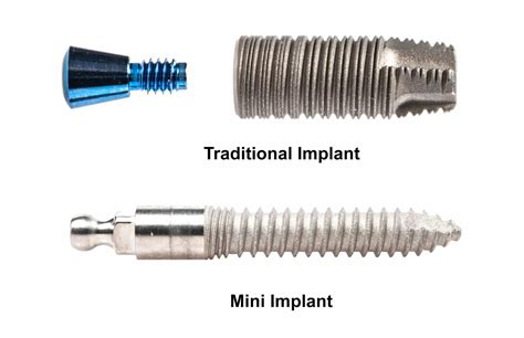 Benefits and Risks of Dental Implants - Sterling, VA