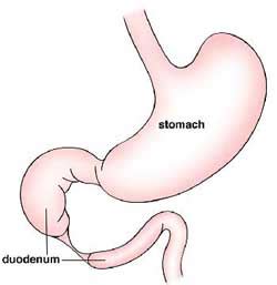 Intestinal Atresia & Stenosis | Types, Diagnosis & Treatment