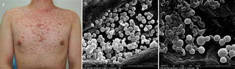 Observation of Fungi, Bacteria, and Parasites in Clinical Skin Samples Using Scanning Electron ...