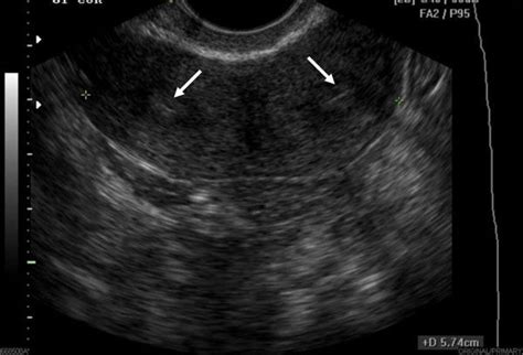 Online CME: Saline Infusion Sonohysterography | Diagnostic medical ...