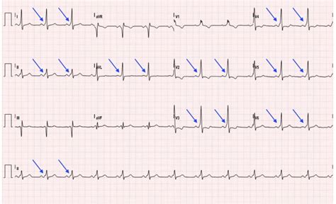 WPW EKG 4, annotated delta waves. JETem 2016 - JETem