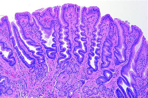 Reactive gastropathy definition, causes, symptoms, diagnosis & treatment