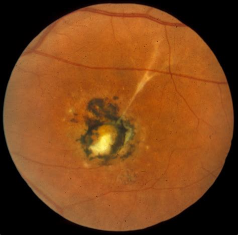 Macular Dystrophy, Vitelliform 2 | Hereditary Ocular Diseases