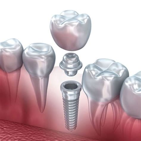 The Anatomy of a Dental Implant