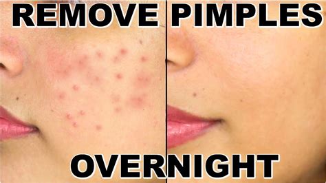 How To Remove Pimples Overnight | Acne Treatment | Shru... | Doovi