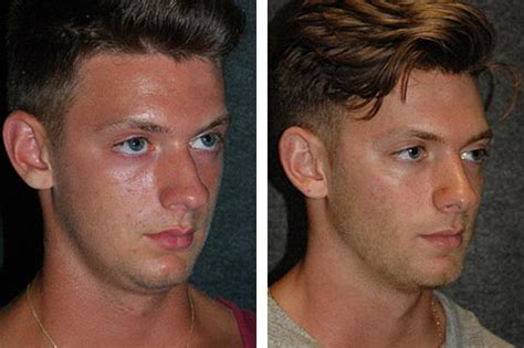 Male Rhinoplasty | New York, NY