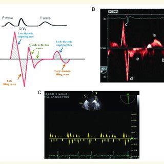 Left atrial appendage evaluation by transoesophageal echocardiography ...