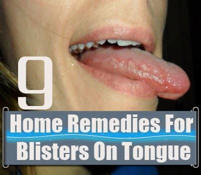 9 Home Remedies for Blisters On Tongue ~ Mzizi Mkavu