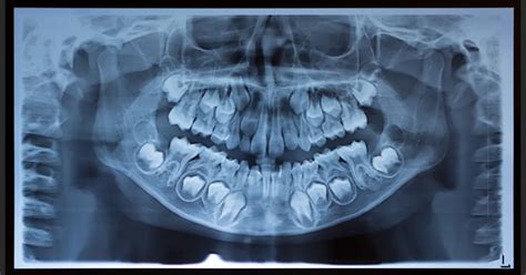 What is Mixed Dentition in Kids? - Dr.Siva Nagini