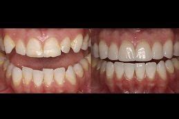 Protruded Teeth Treatment in Dubai & Abu Dhabi | Protruded Teeth Cost