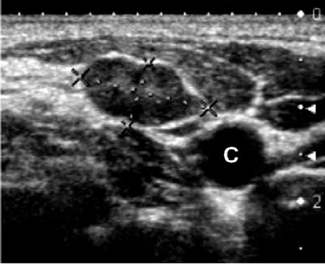 Case of medullary thyroid cancer treated surgically 7 years ago, with a ...