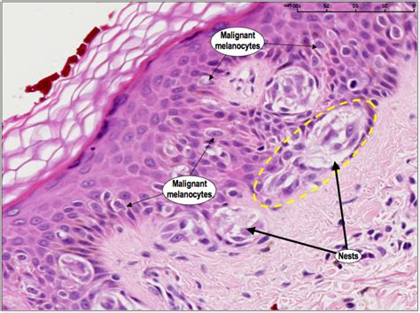 HistoQuarterly: SUPERFICIAL SPREADING MALIGNANT MELANOMA | Histology Blog