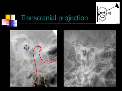 PPT - Radiographic examinations of the temporomandibular joint PowerPoint Presentation - ID:3373885