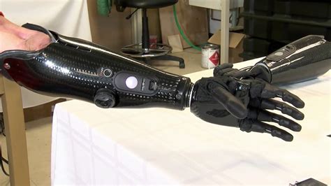 Bionic arm made by UI alum is changing the world of prosthetics | WRSP