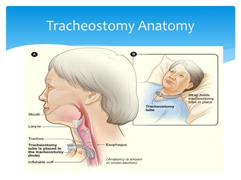 Tracheostomy Care Ati Template