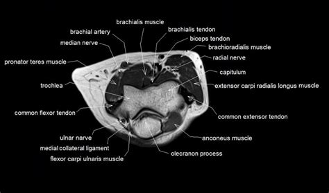 MRI Anatomy of Elbow | Axial Cross Sectional Anatomy of Elbow Joint