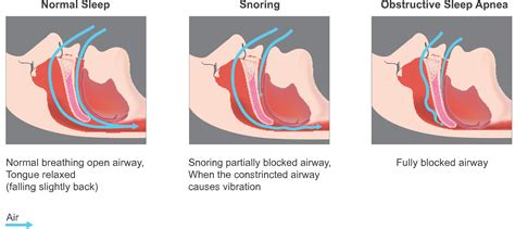 Sleep Apnea Treatment in Mission Viejo CA | Dr. Gannon Lee