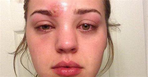 This Woman's Horrifying Story About Popping Pimples Will Make You Never Want to Touch Your Face ...