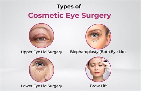 Types of Eye Cosmetic Surgery: From Aesthetics to Vision Correction - M ...